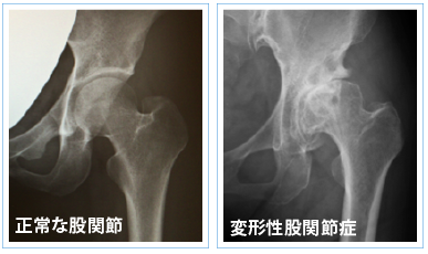 正常な股間節・変形性股関節症の画像